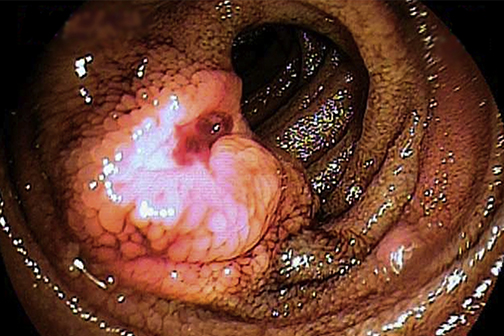 ileal carcinoid tumor